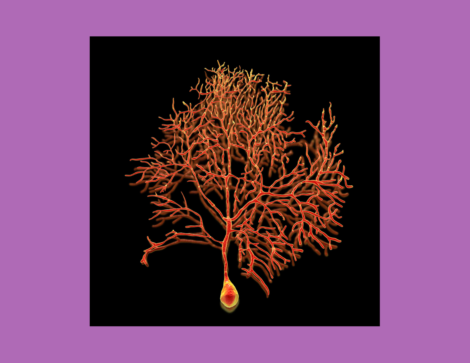Image of neuron, representing pain receptors responsible for signaling referred pain in the body, such as the arm hurting during a heart attack. 
